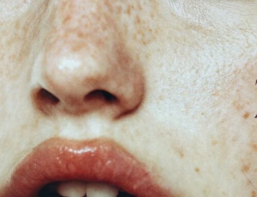 Taches pigmentaires : comment retrouver un teint uniforme et lumineux